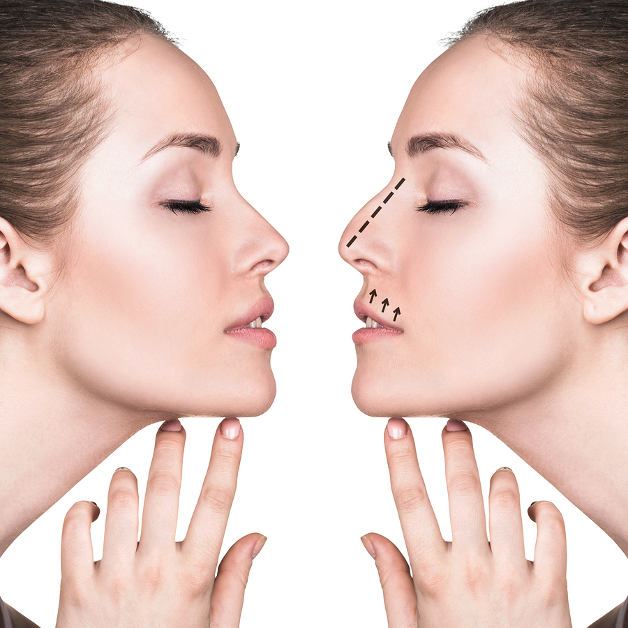 Nose Surgery