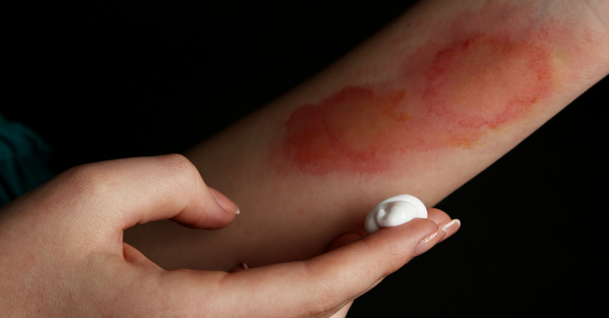At-home First Aid for Burns: what to do and what to avoid